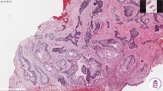 Ameloblastoma Conventionalmulticystic type [upl. by Aneetsirk]