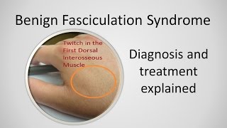 Benign Fasciculation Syndrome Causes and Treatment [upl. by Arathorn]