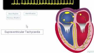 ECG Rhythm Review SVT Atrial Fibrillation Atrial Flutter [upl. by Woodie]