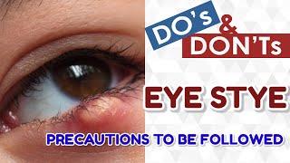 Do and donts in stye eye infection effective home remedies to stop stye infection [upl. by Maye508]