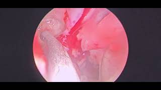 Polyp arising from margin of maxillary sinus opening  Dr Hitesh Patel [upl. by Anirrok]