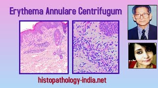 Pathology of Erythema Annulare Centrifugum  Dr Sampurna Roy MD dermpath dermatopathology [upl. by Audres]