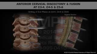 Anterior Cervical Discectomy amp Fusion at C34 C45 amp C56 [upl. by Julissa]