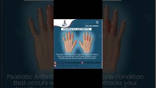 Psoriatic arthritis treatment [upl. by Ykcor397]