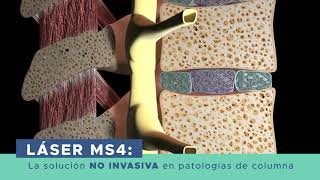 Tratamiento para Hernias Discales con Terapia Láser de Alta Potencia [upl. by Norb742]