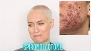 My Spironolactone amp Differin Experience  How I Cleared My Acne In 3 Months  Kiki G [upl. by Anneg186]