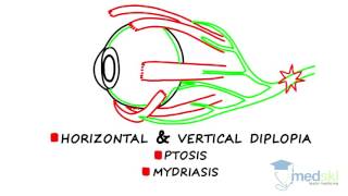 Ophthalmology – Diplopia By Martin ten Hove MD [upl. by Ahsinuq632]