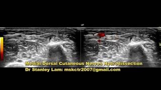 MSK US Guided Medial Dorsal Cutaneous Nerves Hydrodissection [upl. by Nij]