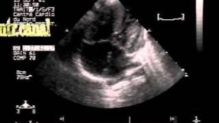 complete atrioventricular canalseptal defect [upl. by Nellaf382]