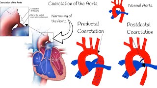 Coarctation of the Aorta  Symptoms Diagnosis and Treatment [upl. by Shiverick]