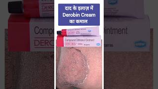 दाद के इलाज़ में Derobin Cream का कमाल Treatment of Ringworm derobin Betnovate tinea luliconazole [upl. by Kimber295]