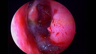 Left inverted papilloma with sinonasal polyposis [upl. by Gamaliel]