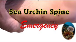 Sea Urchin Spine Emergency in the Dominican Republic [upl. by Adnilemreh496]