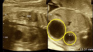 34 weeks pregnancy  Fetal hydronephrosis  Amader hospital  Ultrasonography report  Part  1 [upl. by Dlabihcra]