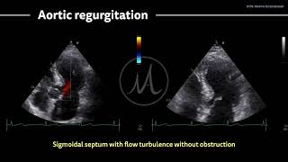 〖Echocardiography〗 Sigmoidal septum amp mild aortic regurgitation [upl. by Ynaffyt]