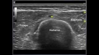 Radial Nerve  humerus to elbow Sonoanatomy  QMH AED Ultrasound Casebook 2013 Video 7 [upl. by Sievert793]