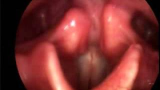 Singing Vocal Folds [upl. by Rillis]