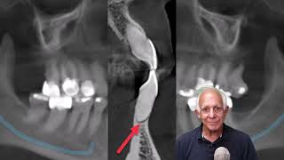 3 Top Factors for Deciding When to Extract a Tooth in 2024 [upl. by Anuahsal]