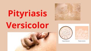 Comment guérir le Mycose cutanée Pityriasis versicolor [upl. by Leahpar]