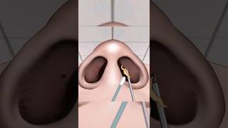 ASMR Remove unmanaged piercing pus animation  Squeeze nose acne asmr shorts [upl. by Anelehs]