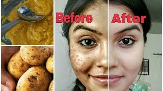 Remove dark spots in just 7 days  100 Natural  Get rid of uneven skintone [upl. by Eilahs]