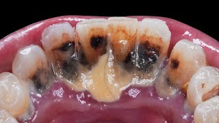 Deep Cleaning With HEAVY Tartar Build Up At The Dentist [upl. by Portland979]