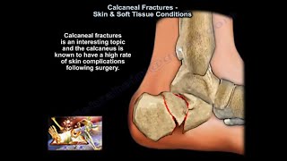 Calcaneal Fractures Skin amp Soft Tissue Condition  Everything You Need To Know  Dr Nabil Ebraheim [upl. by Tonjes]