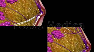 Mastitis  Animated Atlas of Breast and Gastric Cancer [upl. by Esilec]