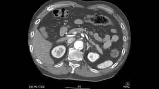 Aortic Dissection  QMH AED Ultrasound Casebook 201409 Video 7 [upl. by Rhianna]