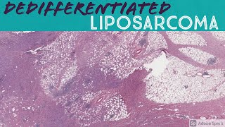 Dedifferentiated liposarcoma with heterologous osteosarcoma component [upl. by Ylicec21]