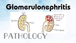 Glomerulonephritis Pathology [upl. by Cobby]