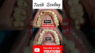 🇳🇵Brush your teeth daily Dental Scaling Tartar Cleaning Deep cleaning Kathmandu Dentist Dr Dentalk [upl. by Ariada]