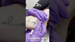 Ganglion Cyst Quiste ganglionar  DrOrlando Nuñez 👨‍⚕️  Minimally Invasive Foot Surgery [upl. by Notyard]