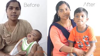 Cleft Lip Cleft Palate Before and after pictures [upl. by Adnoek]