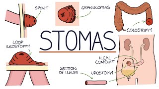 Understanding Stomas Colostomy Ileostomy Urostomy and Gastrostomy [upl. by Nnylyma795]