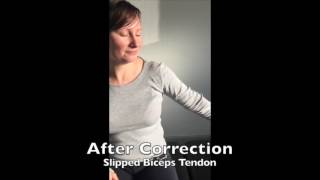 Slipped Biceps Tendon Correction [upl. by Ayhdnas284]