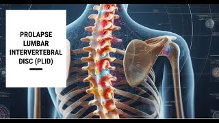 Lumbar Intervertebral Disc Prolapse PLID [upl. by Anat226]