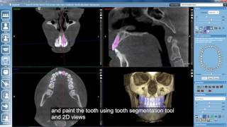 Planmeca Romexis 3D Ortho Studio – Orthodontic treatment planning with roots and [upl. by Hebel]