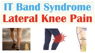 Iliotibial IT Band Syndrome Common Cause of Lateral Knee Pain  Symptoms Diagnosis Treatment [upl. by Ditzel]