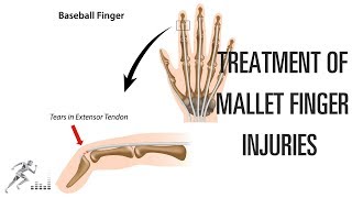 Mallet finger Treatment of this difficult finger injury [upl. by Harri]