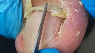 Separate The Ingrown Toenail And Dig Out A Lot Of Dead Skin [upl. by Puduns]