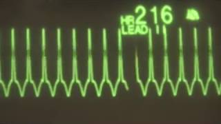 Supraventricular Tachycardia  ECG Training [upl. by Siro472]