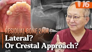 잔존골 2mm의 Sinus grafting case ⎮ 덴사버를 이용한 Crestal approach로 해결하기 [upl. by Retep]