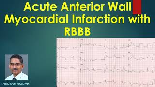 Acute Anterior Wall Myocardial Infarction with RBBB [upl. by Merfe303]