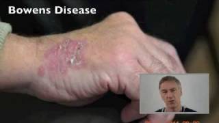 Dr Ashworth Bowens Disease [upl. by Michael876]