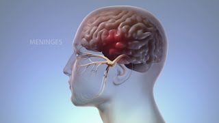 What Happens In Your Body During Migraine  WebMD [upl. by Gisela]