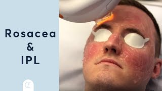 Rosacea Treatment at Pulse Light Clinic London [upl. by Kempe]