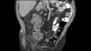 Dedifferentiated liposarcoma mimicking a primary colon mass  CT scan [upl. by Deadman]