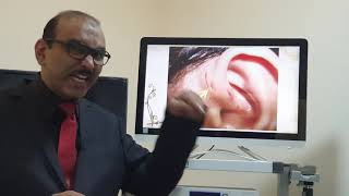 Preauricular sinus Malayalam Patient teaching programme [upl. by Schober858]