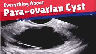 Para Ovarian Cyst  Ultrasound  How to Diagnose  Complications [upl. by Athalla179]